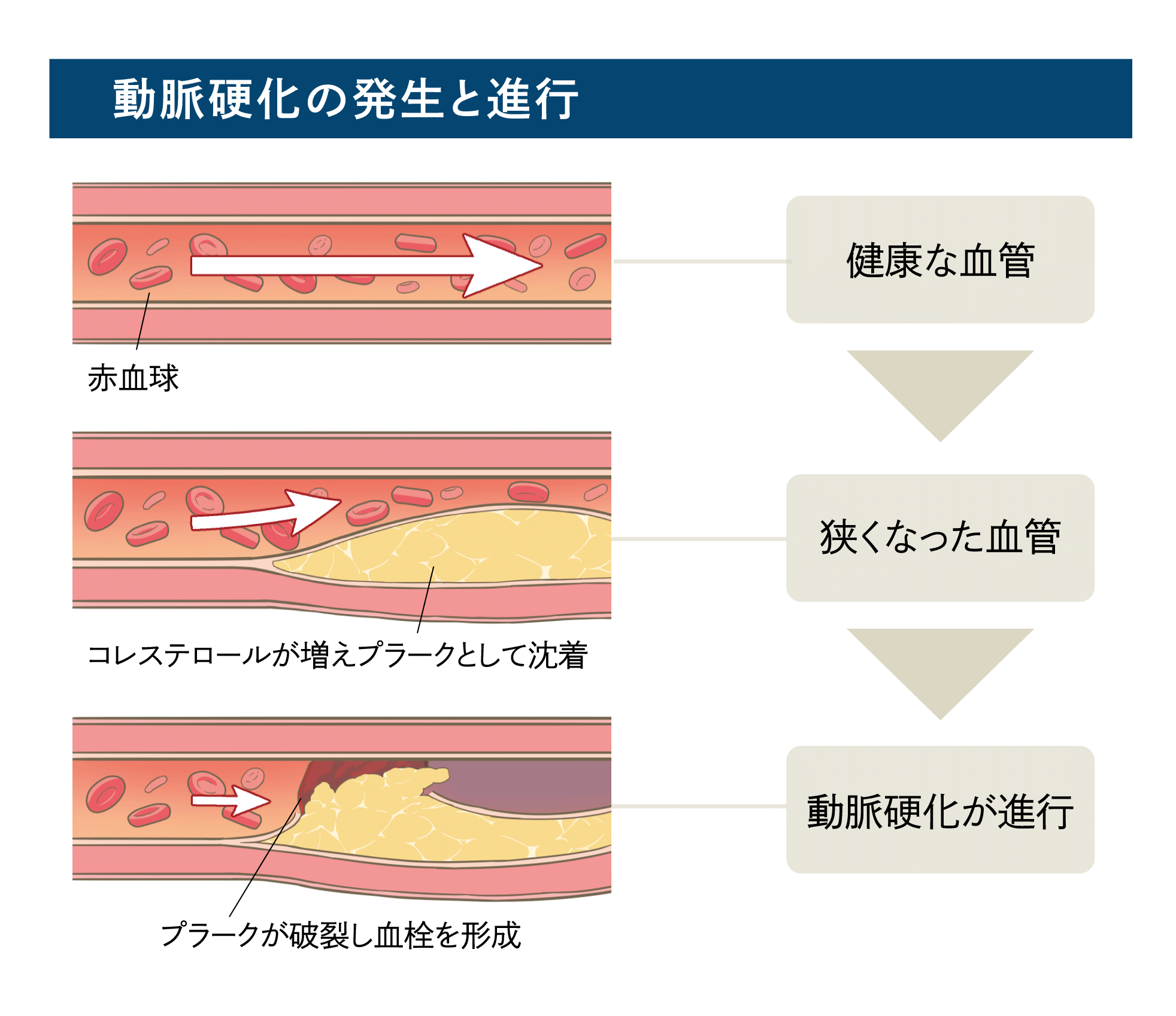 動脈硬化の発生と進行